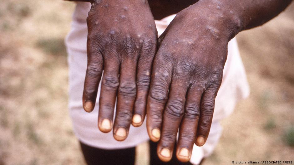 Mpox: Cabinda confirme 264 cas et deux décès
